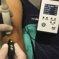 Técnica EPI®️ /EPI®️ technique Electrolisis Percutanea