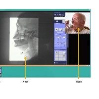 PharyDoc- Speech Videofluoroscopy Bildteknik