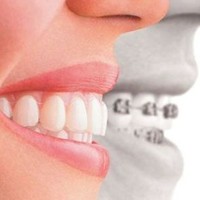 Niềng Răng 3D Clear Aligner