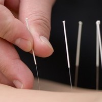 Acupuncture Warwickshire