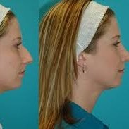 Rodeodriver hinoplasty