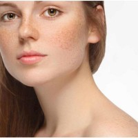 Điều Trị Nám Da