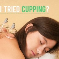Chinese Cupping Therapy