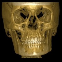 Advanced Dental Imaging of MI