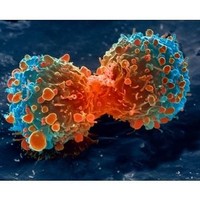 Advancement Cancer